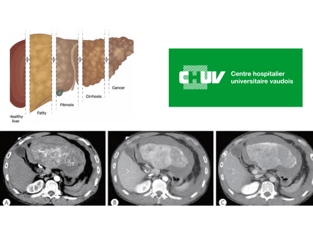 Predicting recurrence after hepatocellular carcinoma resection using deep learning on gross tumor images teaser figure